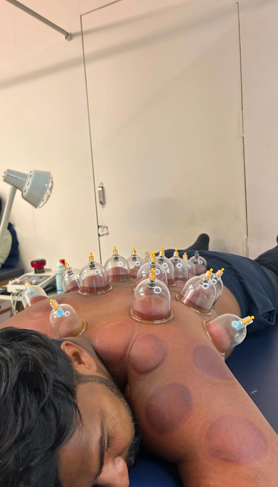 Cupping therapy session at the Guide Physio clinic